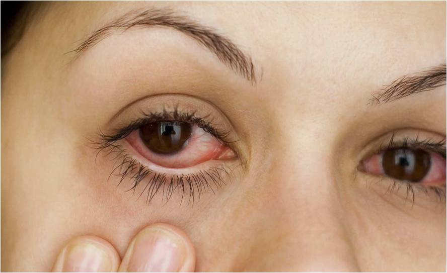 Agevisa-PB recomenda alerta máximo após problemas oftalmológicos causados por cosméticos