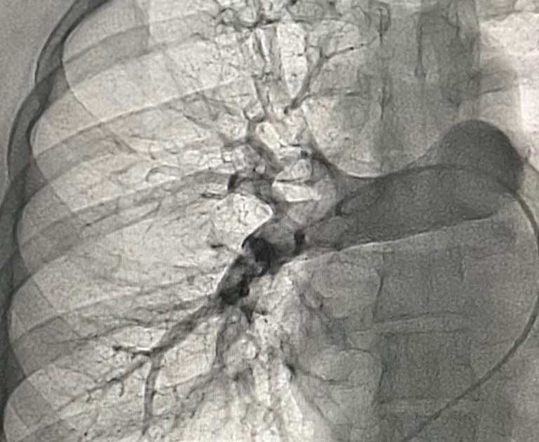 Procedimento de alta complexidade realizado na Hemodinâmica de Patos salva a vida de sertanejos