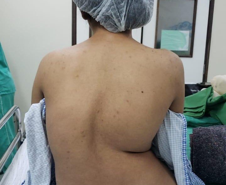 governo amplia cirurgias de escoliose no complexo pediatrico arlinda marques e fortalece assistencia especializada